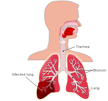 Klebsiella Pneumoniae Arrangement